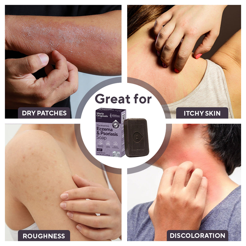 Home Essentials Eczema and Psoriasis Relief Soap for daily home and personal routines with bath body and hygiene